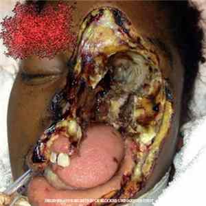 Nasopharyngeal Carcinoma of the Mucosal Epithelium in the Nasopharynx - Degenerative Secretion of Blocked Urinary Content FLAC album