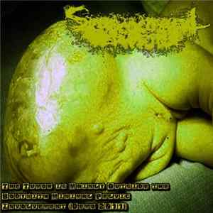 Sacrococcygeal Teratoma - The Tumor Is Mainly Outside The Body With Minimal Pelvic Involvement FLAC album
